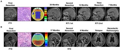 Molecular characterization of sub-frontal recurrent medulloblastomas reveals potential clinical relevance